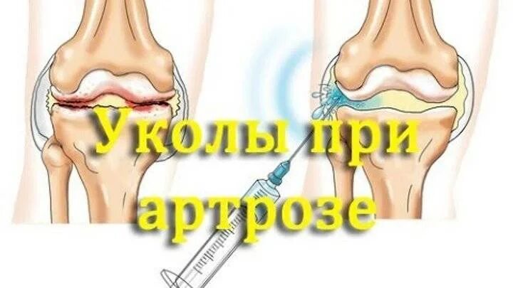 Пункция синовиальной жидкости. Препараты хондропротекторы для суставов уколы. Остеоартроз коленного сустава уколы. Остеоартроз коленного сустава уколы. Внутрисуставные инъекции гкс.