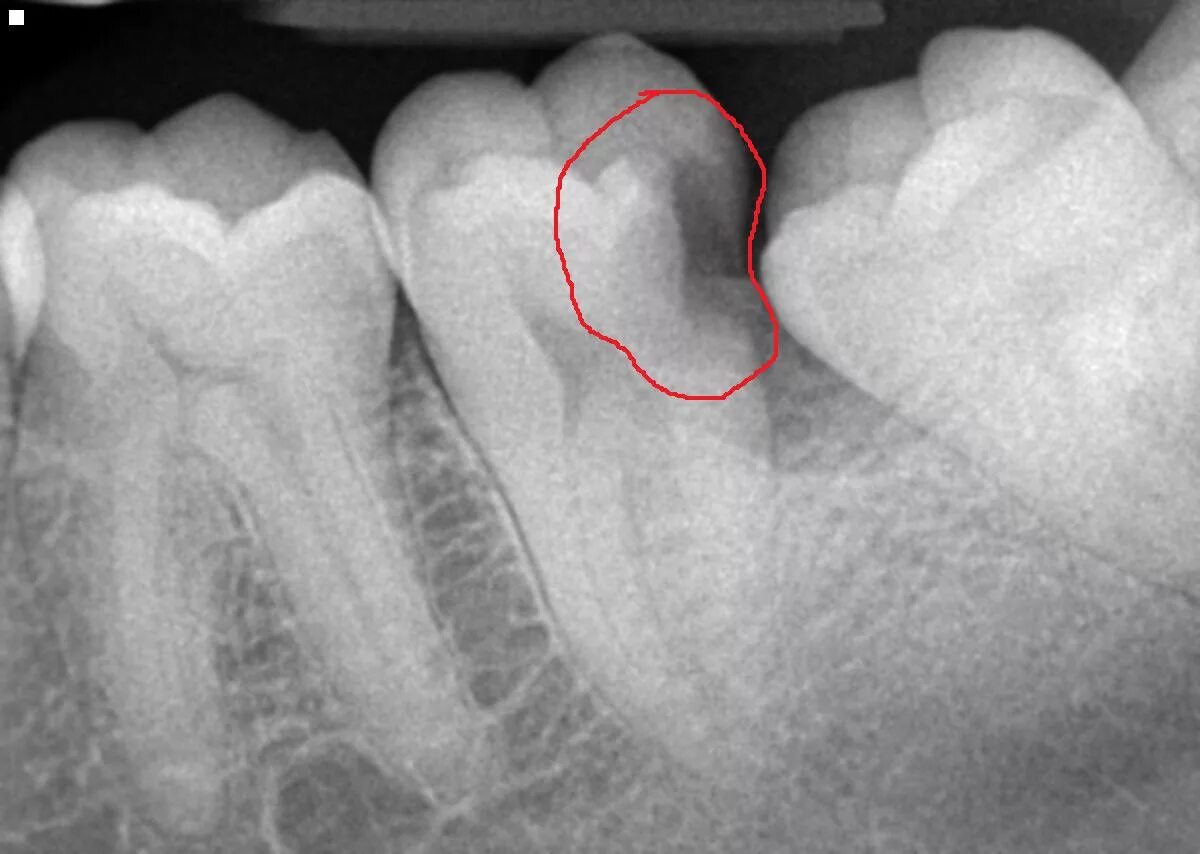 Пришеечный кариес, кариес корня зуба. Острый диффузный пульпит рентген. Пульпит временных зубов рентген.