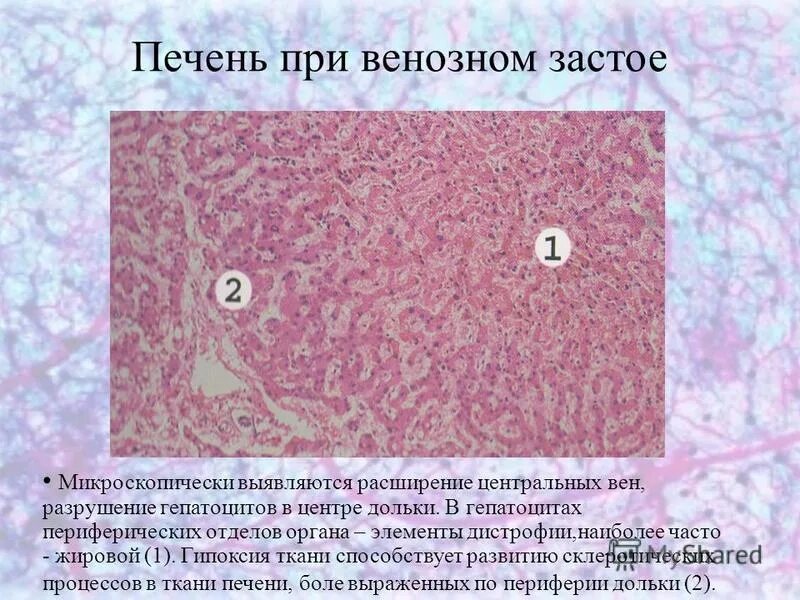 Печень при хроническом венозном застое. Венозное полнокровие печени гистология. Венозное полнокровие печени мускатная печень. Венозное полнокровие печени макропрепарат. Венозное полнокровие селезенки.