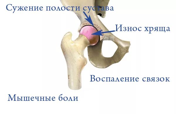 Боль в тазобедренном суставе. Тазобедренный сустав болит. Болит тазобедренный Су тав. Бдль тазобедренный сустав. Боль в тазобедренном суставе правой ноги