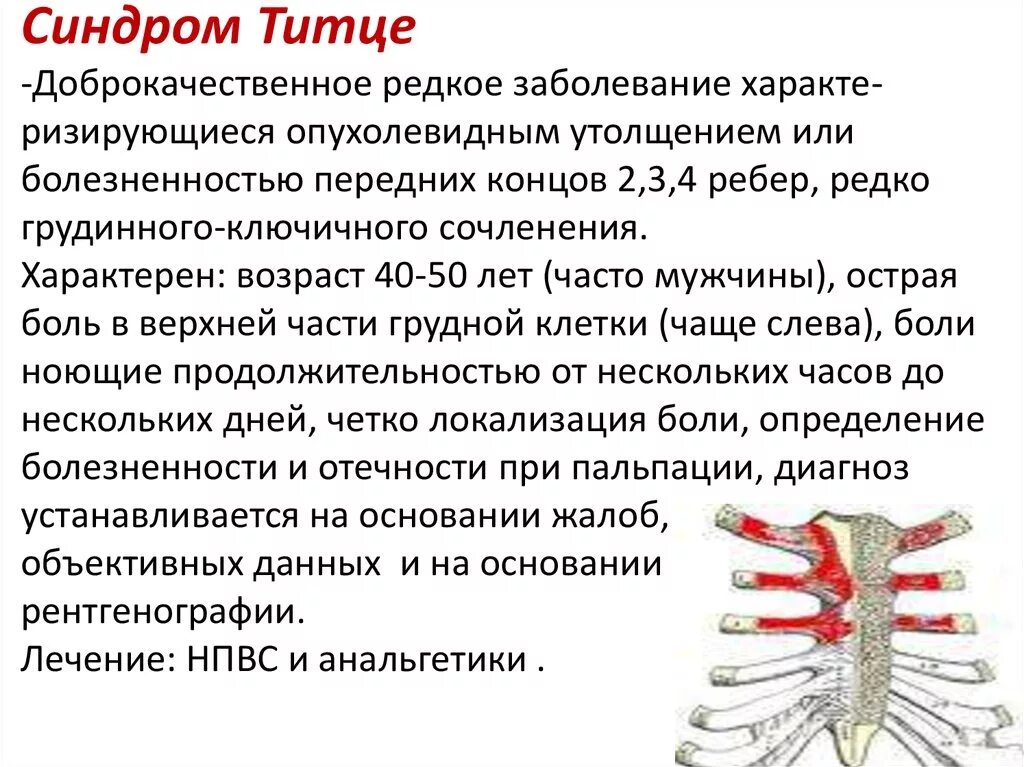 Почему может болеть грудная. Синдром Титце хондрит реберный. Реберно-грудинное сочленение Титце. Воспаление реберных хрящей. Боль при синдроме Титце.