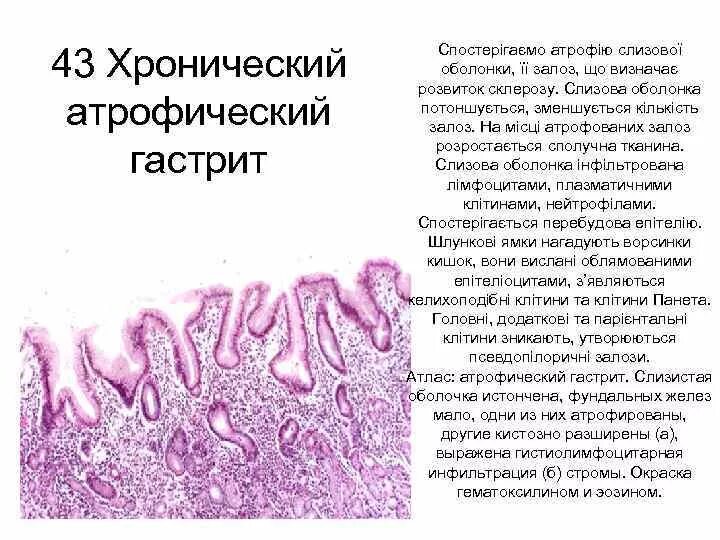 Хронический хеликобактерный гастрит микропрепарат. Десквамация эпителия бронхов гистология. Патанатомия хронический атрофический гастрит микропрепараты. Кишечная метаплазия желудка гистология. Метаплазия желудка гистология.