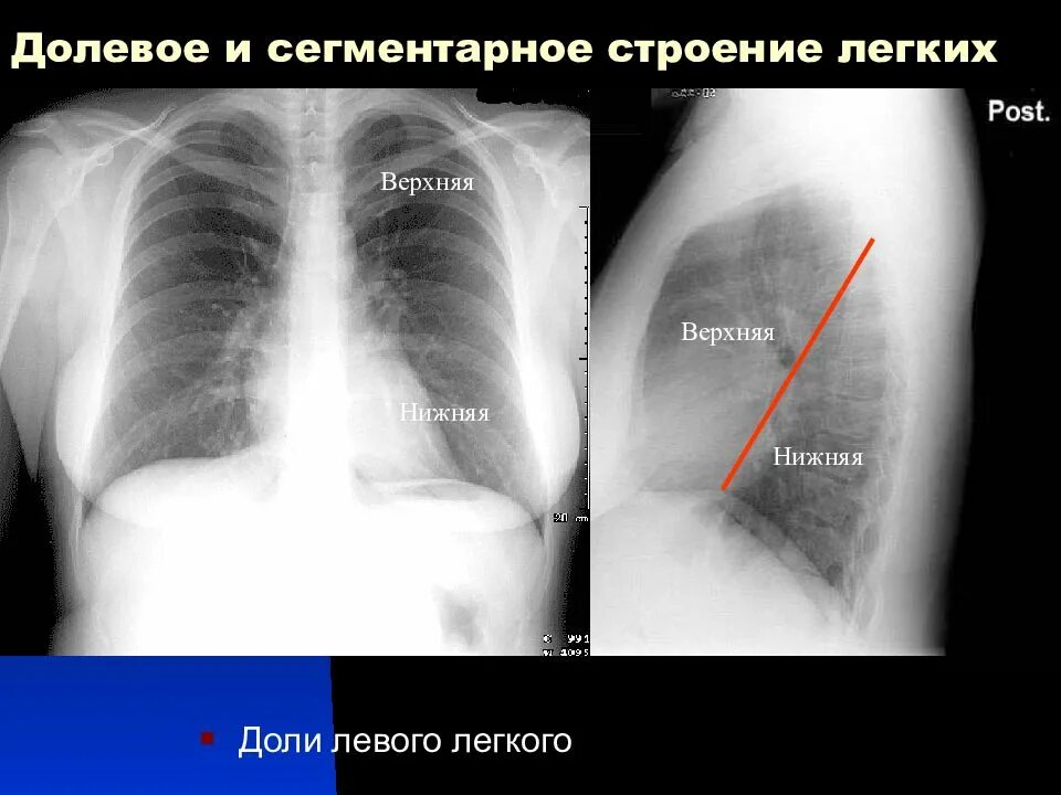 Нижнедолевая пневмония слева рентген. Сегментарная пневмония рентген. Междолевые щели легких на рентгенограмме. Междолевые щели на рентгене легких. Пневмония в нижней доле правого легкого