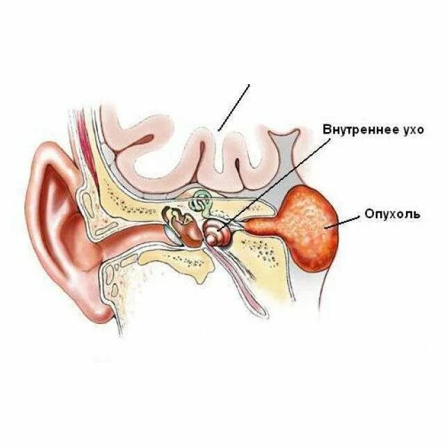 Почему давит на уши. Невринома слухового нерва на кт.