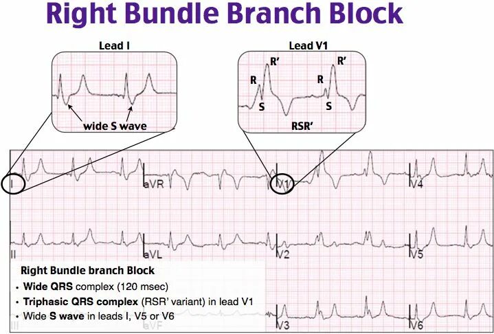 Right bundle branch block экг. Уно error карта блокировка. Lbbb экг это. Это приложение было заблокировано вашим системным администратором. Ecg right branch bundle block.