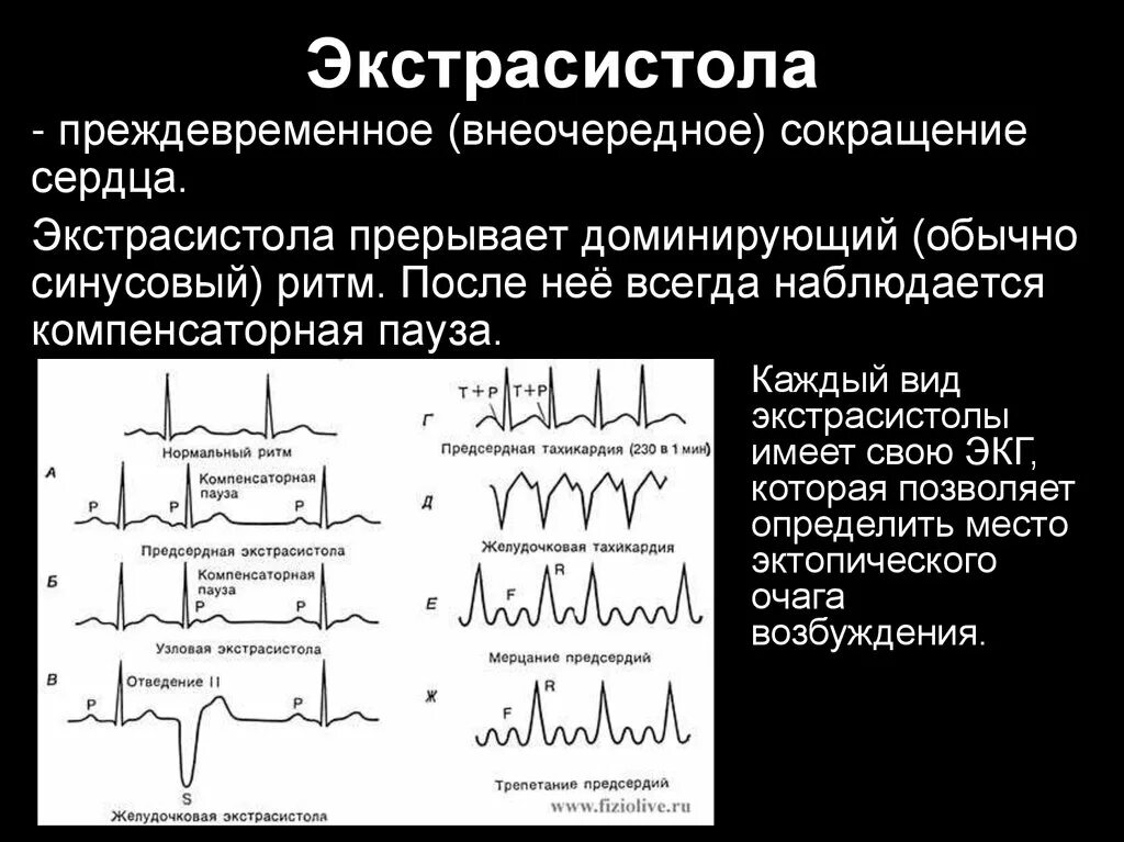 Предсердная экстрасистолия физиология. Синусовая экстрасистола физиология. Синусовая экстрасистолия на ЭКГ. Предсердная экстрасистолия компенсаторная пауза.