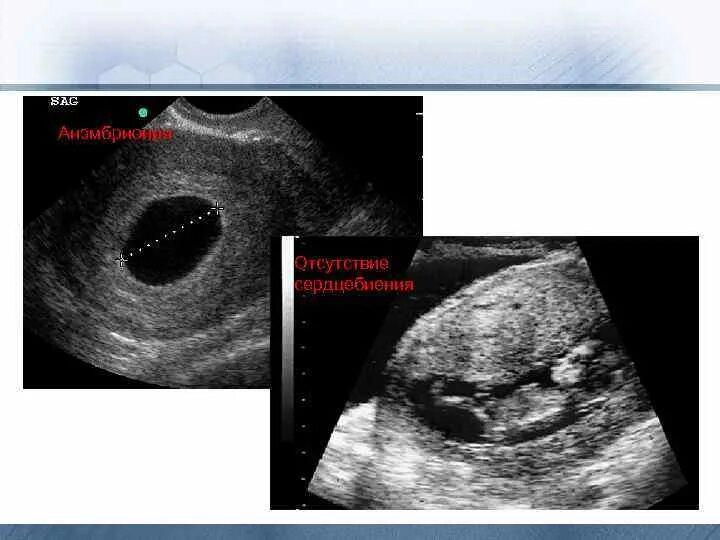 Неразвивающаяся беременность 7 недель УЗИ. Беременность анэмбриония.