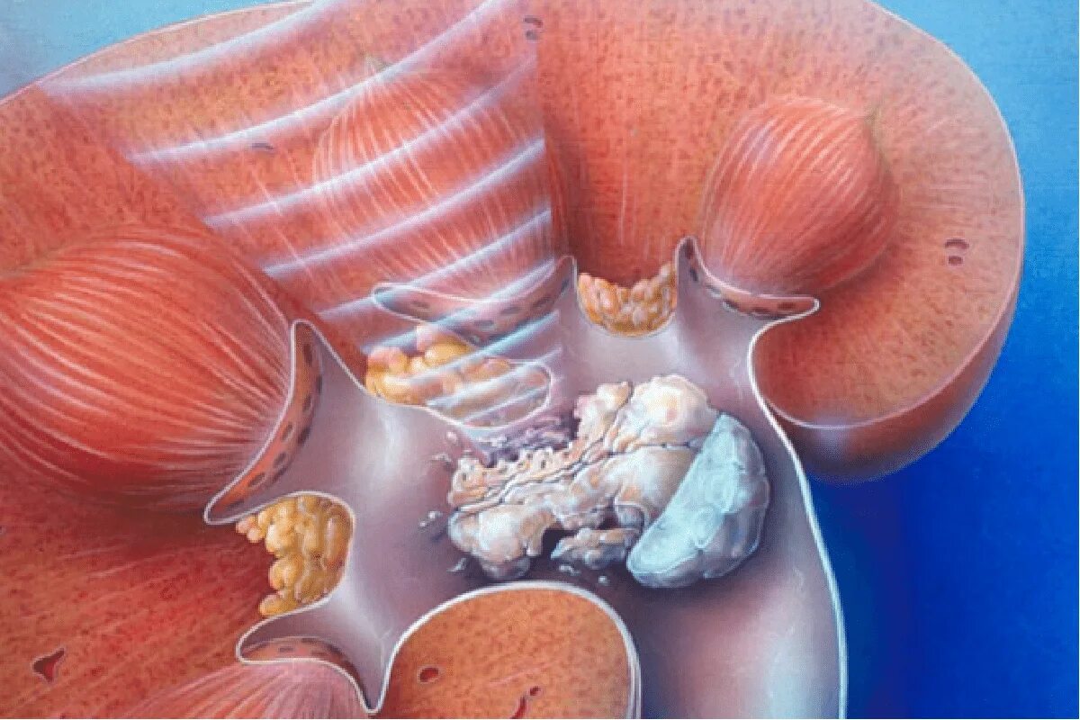 Камни в почках заболевание. Мочекаменная болезнь коралловидные камни. Мочекаменная болезнь (нефролитиаз). Камни в почках (конкременты). Коралловый нефролитиаз.