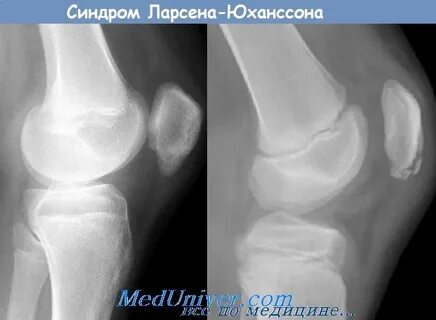 Ларсена йохансона