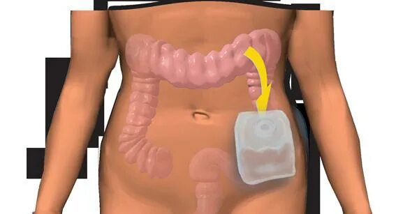 Colostomy Ileostomy Sigmoid colon Stomach Laparoscopy, Descending Colon, hand, s