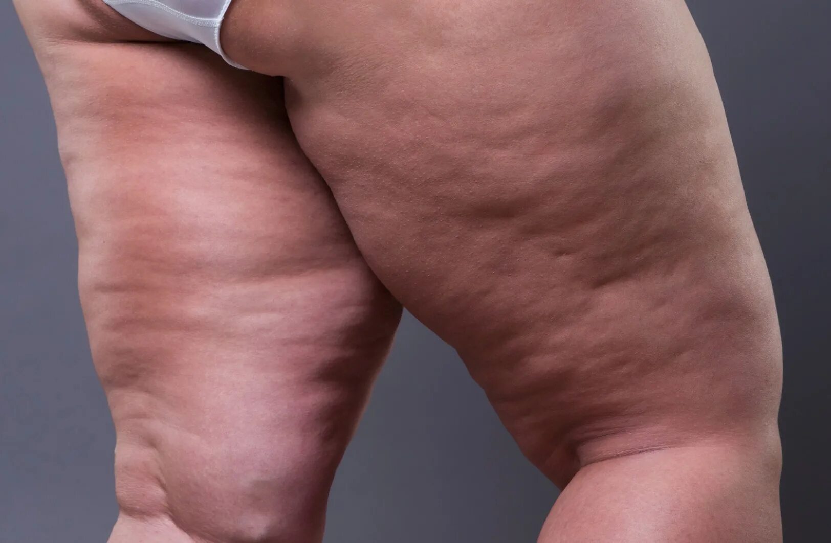 сильный целлюлит. липодистрофия целлюлит. липодистрофия целлюлит. сильный целлюлит. макронодулярный целлюлит.