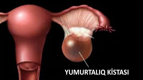 От чего образуются кисты у женщины