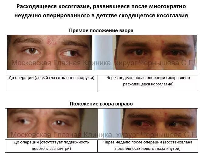 Операция по исправлению косоглазия у детей. Операция по косолапию у взрослых. операция косоглазие у взрослых. глаз после операции на косоглазие. расходящееся косоглазие после операции.