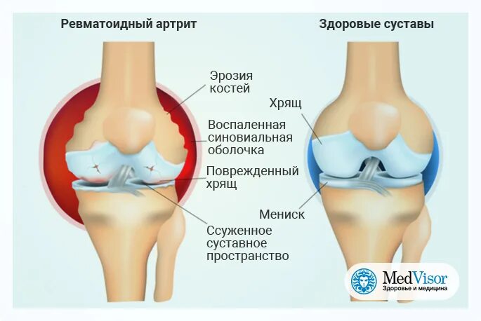 Ревматоидный остеоартрит дебют. Коленный сустав при ревматоидном артрите. Ревматоидный артрит суставы. Ревматоидный артрит при сахарном диабете. Можно греть артроз коленного