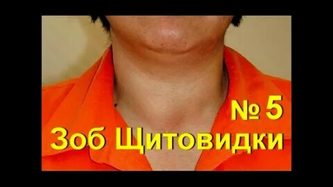 Лечение узловой щитовидной железы