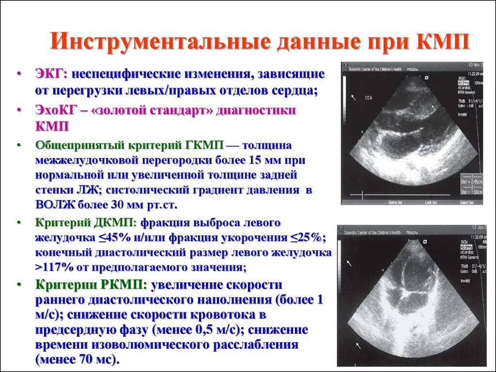 Признаки дкмп на эхокг. Описание узи при остром пиелонефрите. Гипертрофия правого желудочка эхокг. Гипоксия у новорожденного на узи головного мозга. Сморщенная почка узи протокол.