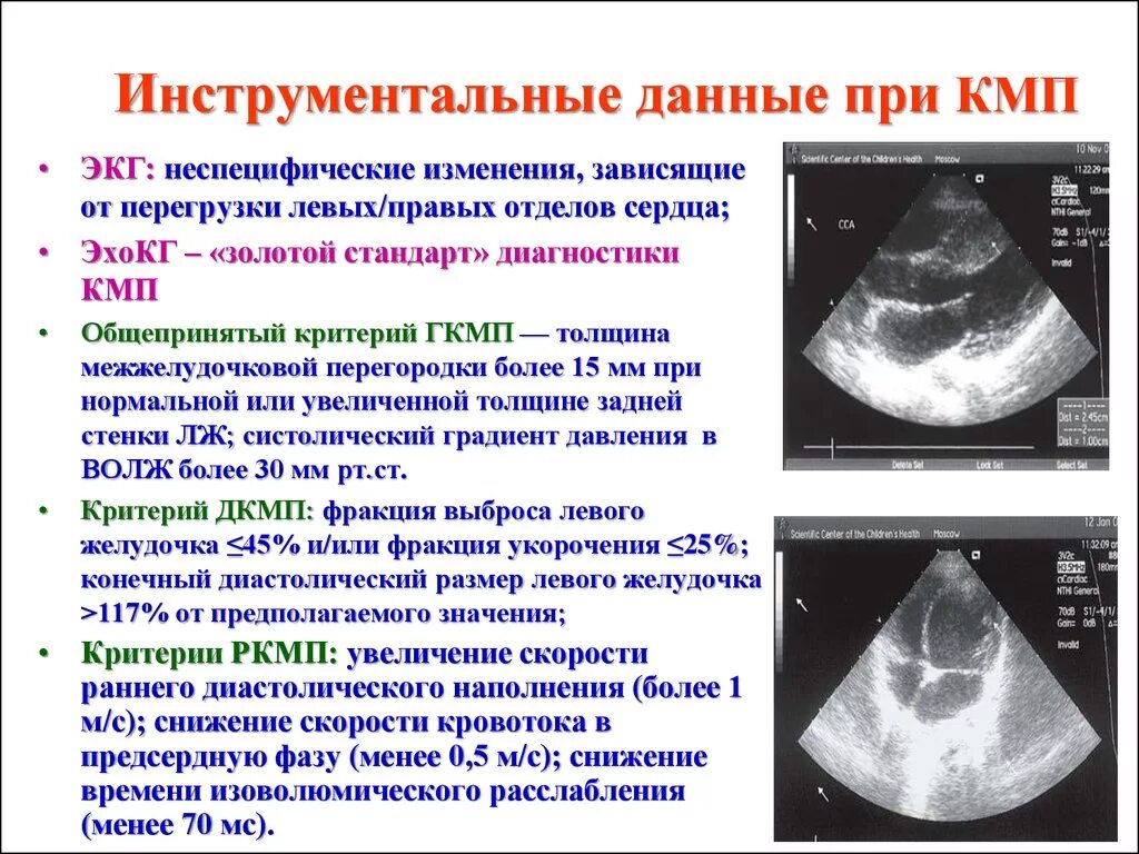 Диффузные изменения лж. Изменения на ЭХОКГ. ЭХОКГ при миокардите. Эхокардиография при миокардите. ЭХОКГ при миокардите сердца.