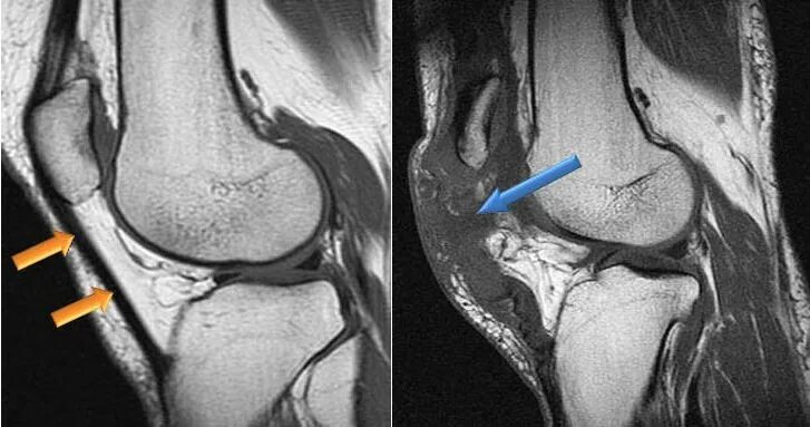 Тендинит надколенника мрт. Лигаментоз надколенника рентген.
