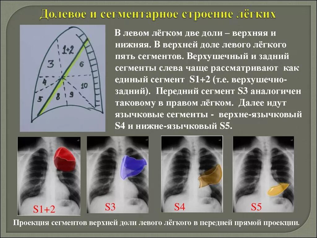 S4 левого легкого. Сегменты легкого на рентгенограмме s1 s2 s3. Сегменты s1 s2 правого легкого. Язычковые сегменты левого легкого рентген. Сегмент 5 верхней доли левого легкого.