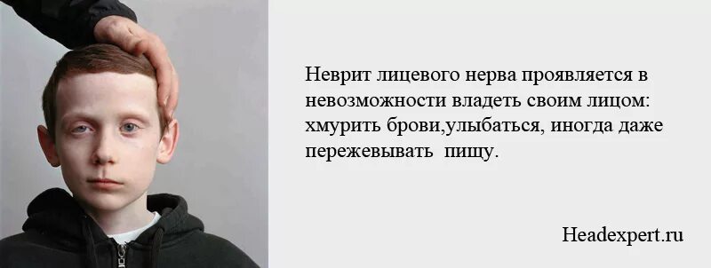 Лицевой неврит. Невропатия лицевого нерва симптомы. Неврит лицевого нерва причины. Неврит лицевого нерва у детей. Неврит лицевого нерва отзывы