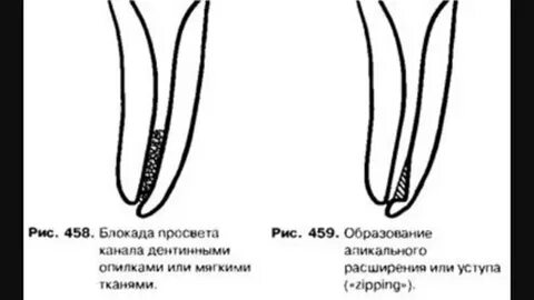 Апикально корональные методы обработки корневых каналов