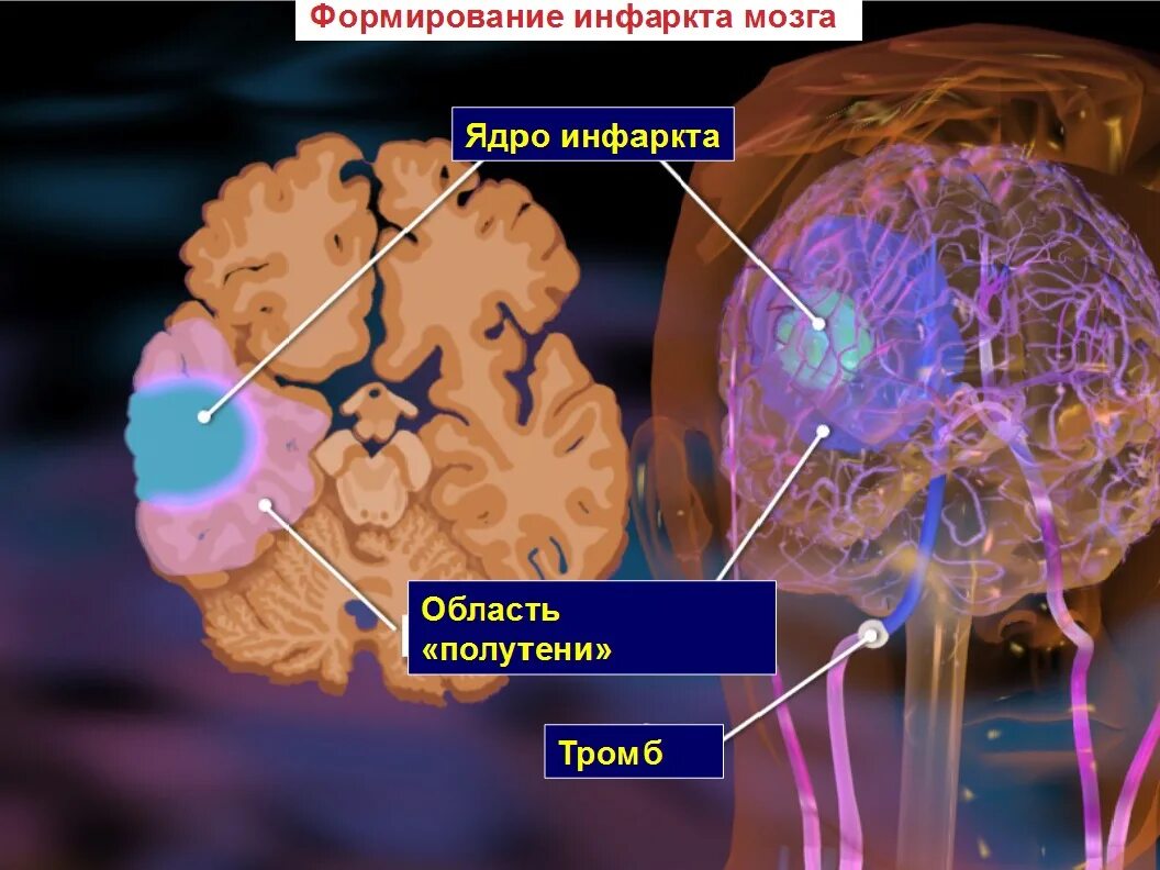 Тромб после инсульта. Ишемический инсульт (инфаркт мозга). Зоны ишемического инсульта. Формирование инфаркта мозга. Тромболитики при ишемическом инсульте.