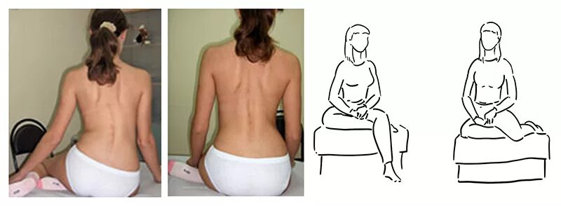 Сколиоз перекос таза рентген. Перекос костей таза рентген. Сколиоз 1 степени и перекос таза. Перекос таза как исправить. Искривление позвоночника смещение таза.