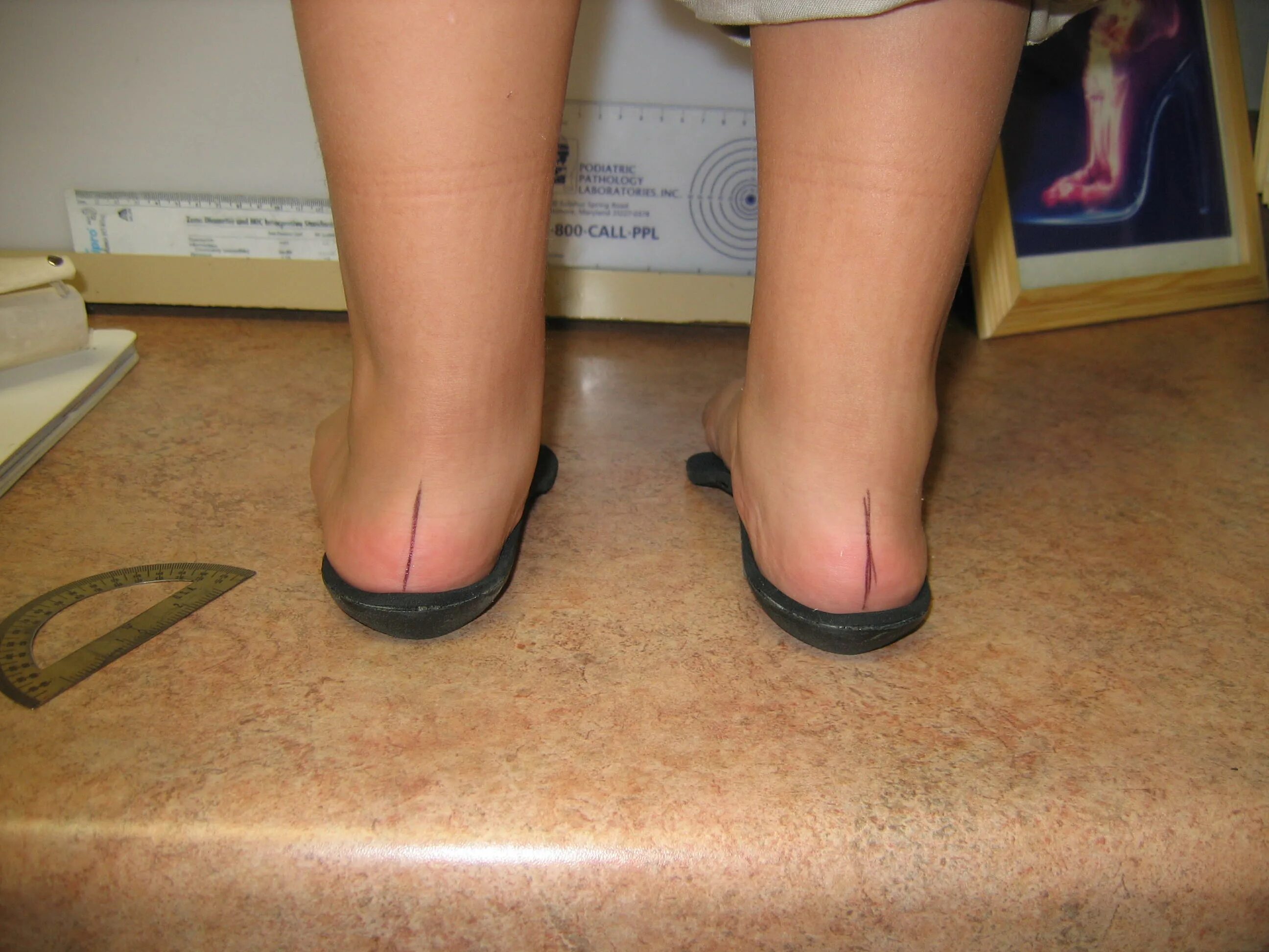 Операция на стопы обувь. Плоскостопие у детей. Вальгусная деформация стопы.