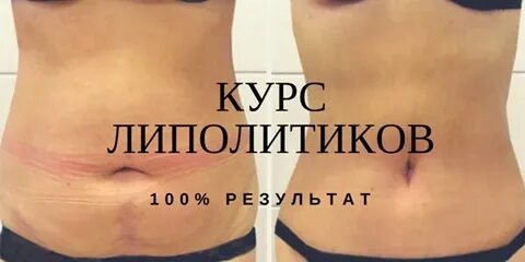 Сколько мл липолитика нужно в живот