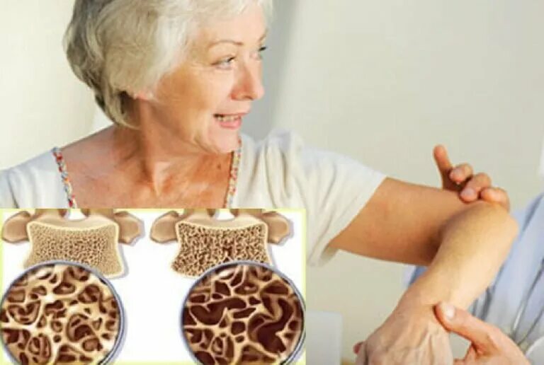 Симптомы остеопороза у женщин после 50 лет. Старческий остеопороз. Остеопороз у женщин. Кости у пожилых людей. Остеопороз у пожилых.