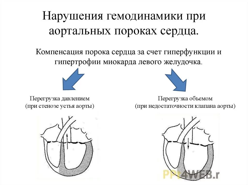 Дегенерация митрального клапана. Механизмы нарушения гемодинамики при пороках сердца. Пороки сердца аортальный стеноз и недостаточность. Механизмы нарушения гемодинамики приобретенные пороки сердца. Аортальные пороки сердца схема.
