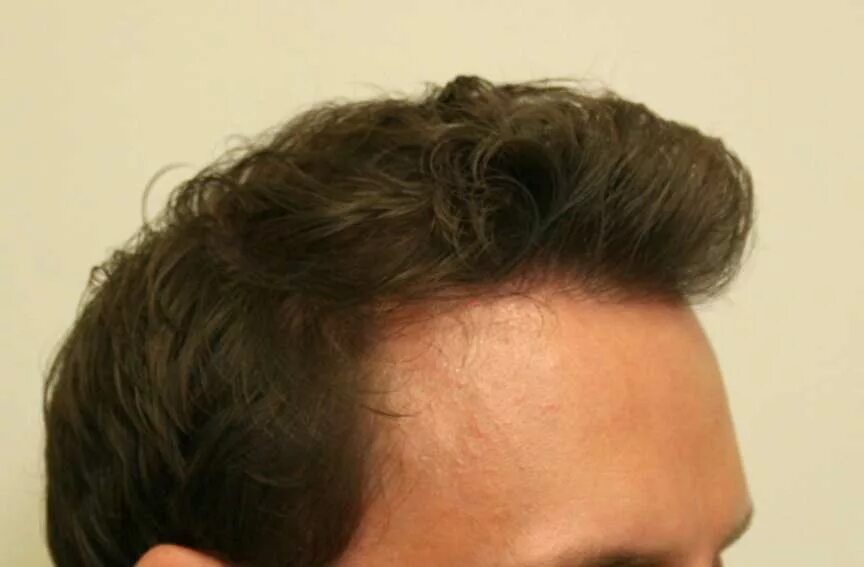 линии роста волос у мужчин на голове. мужские стрижки для роста волос. линия роста волос. м образные волосы. м образная линия роста волос.