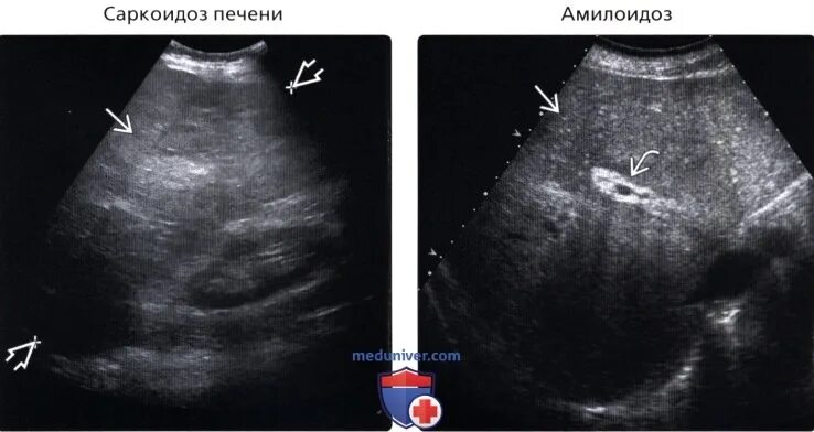 Умеренно диффузно неоднородная. Диффузные изменения печени на УЗИ. Диффузные изменения печени фото. Д Ифузные изменения печени.