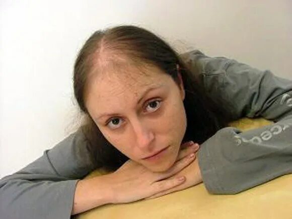 Выпадение волос при химиотерапии. Стрижка при химиотерапии. волосы после химиотерапии. стрижка волос при химиотерапии. прически при химиотерапии.