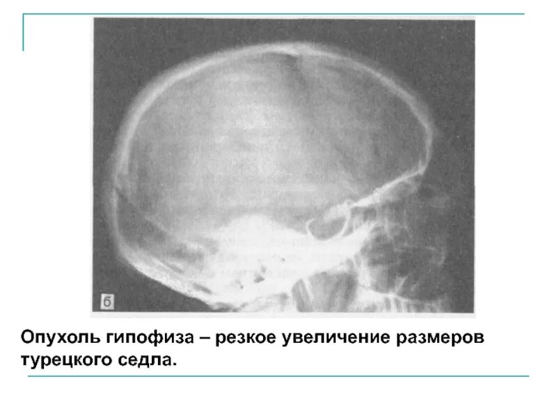 Образование турецкого седла. Опухоль турецкого седла рентген. Рентген турецкого седла опухоль гипофиза. Аденома гипофиза рентген черепа. Образование турецкого седла на кт.