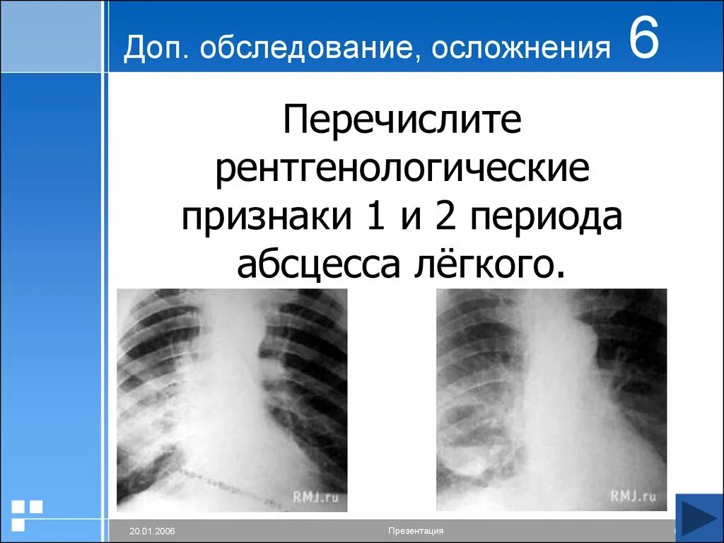 Рентгенологические признаки абсцесса легкого. Первый период абсцесса легких. Стадии абсцесса легкого на рентгенограмме. Абсцесс легкого рентген. 1 абсцесс легкого