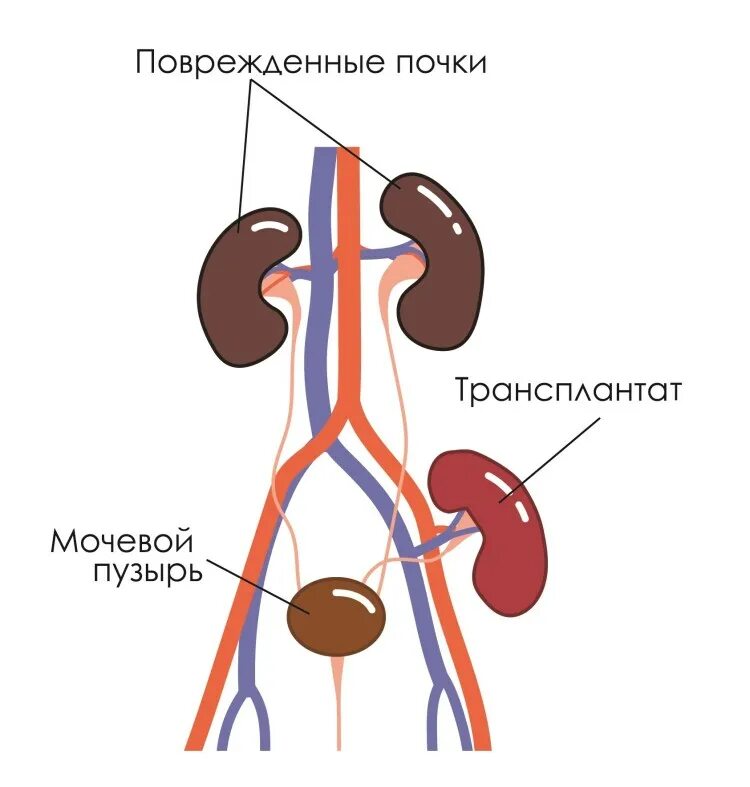 Ортотопическая трансплантация почки. Схема операций трансплантации почки. Пересадка почки в москве