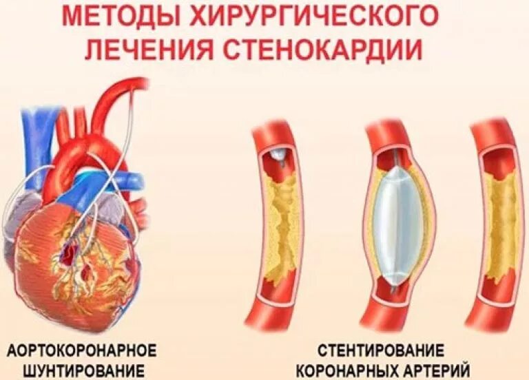 Терапия после стентирования