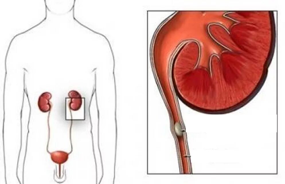 После удаления мочевого пузыря у мужчины. Мочекаменная болезнь мочеточника. Мочекаменная болезнь камни мочеточников клиника. Обтурация мочеточника камнем.