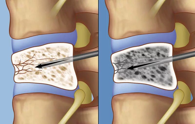 Компрессионный перелом вертебропластика. Компрессионный перелом позвоночника 2 степени. Компрессионный перелом h12. Компрессионный перелом позвоночника поясничного отдела. Компрессионная операция на позвоночнике