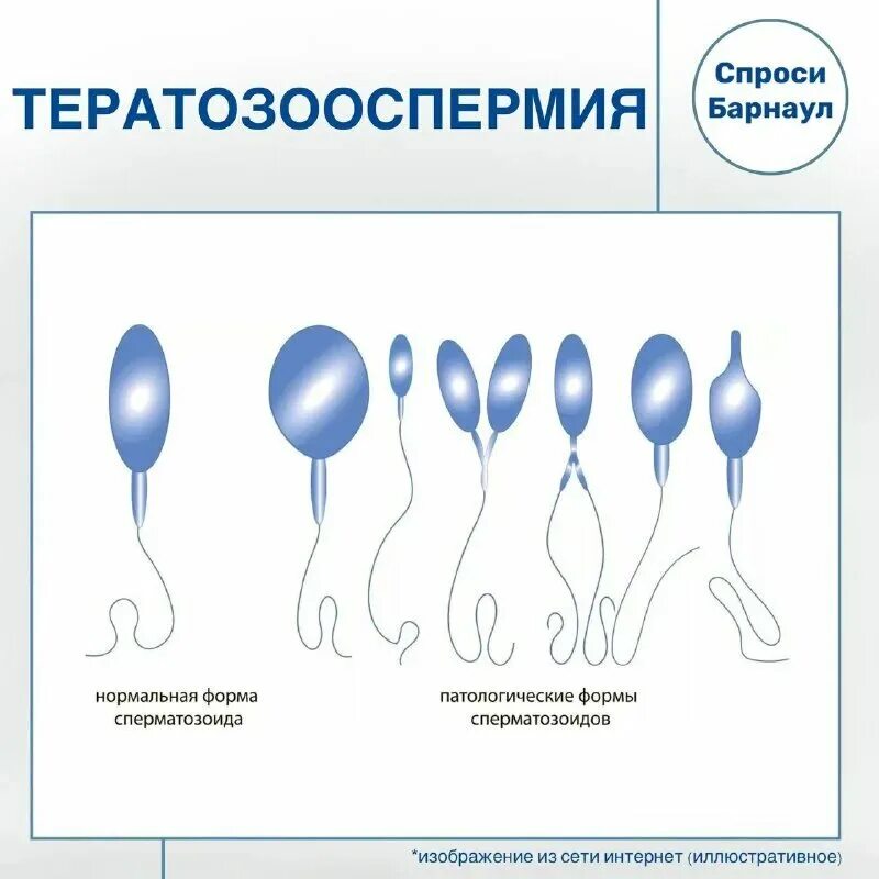 Тератозооспермия что это такое у мужчин причины. Спермограмма с морфологией по крюгеру. Нормальные показатели спермограммы у мужчин. Фрагментация днк сперматозоидов. Тератозооспермия что это такое у мужчин причины.