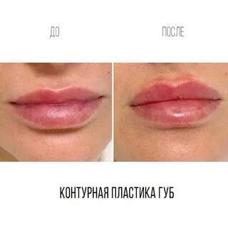 Губы после введения филлеров