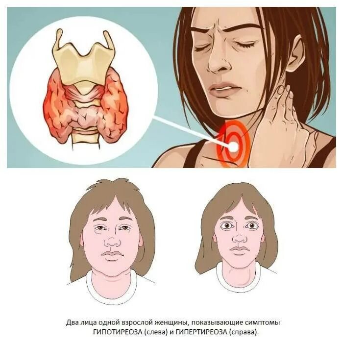 Какие симптомы заболевания щитовидной. Щитов железа симптомы заболевания. Щитовидная железа симптомы заболевания. Щетавитки железа симптоми. Синдромы заболеваний щитовидной железы.