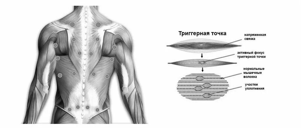 Триггерные точки на спине. Трицепс триггерные точки. Карта триггерных точек. Карта триггерных точек человека. Триггерные точки это простыми словами