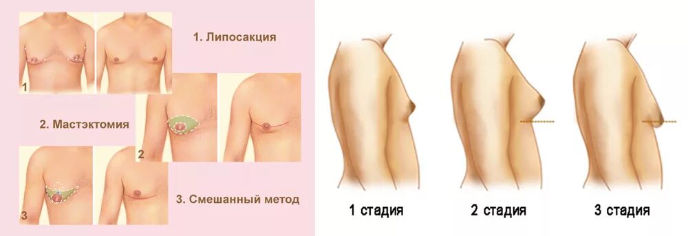 Плотный совсем. Гинекомастия у мужчин 1 стадия. Нормальная грудь. Этапы развития молочных желез. Тубулярность молочных желез.
