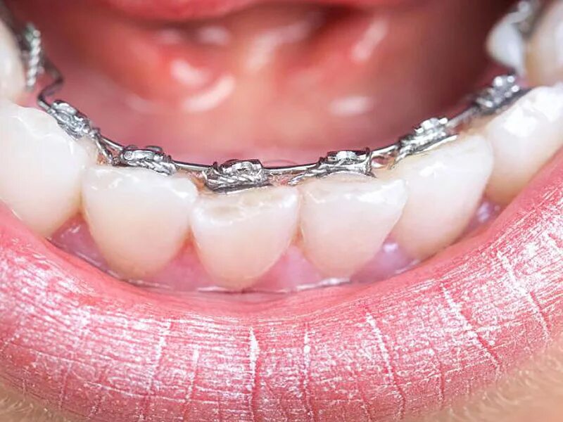 Как называются прозрачные зубы. Прозрачные брекеты. керамические брекеты. бесцветные брекеты. прозрачные брекеты на зубы.