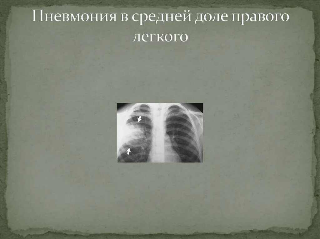 Среднедолевая пневмония рентген. Долевая пневмония средней доли правого легкого. Пневмония в средней доле правого легкого. Пневмония в средней доле. Пневмония в нижней доле правого легкого