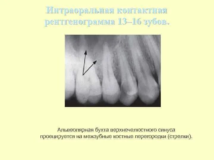 Межзубные костные перегородки. Пародонтит периодонтит пародонтоз. Перелом корня зуба фото. Межкорневая костная перегородка. Межзубные костные перегородки.