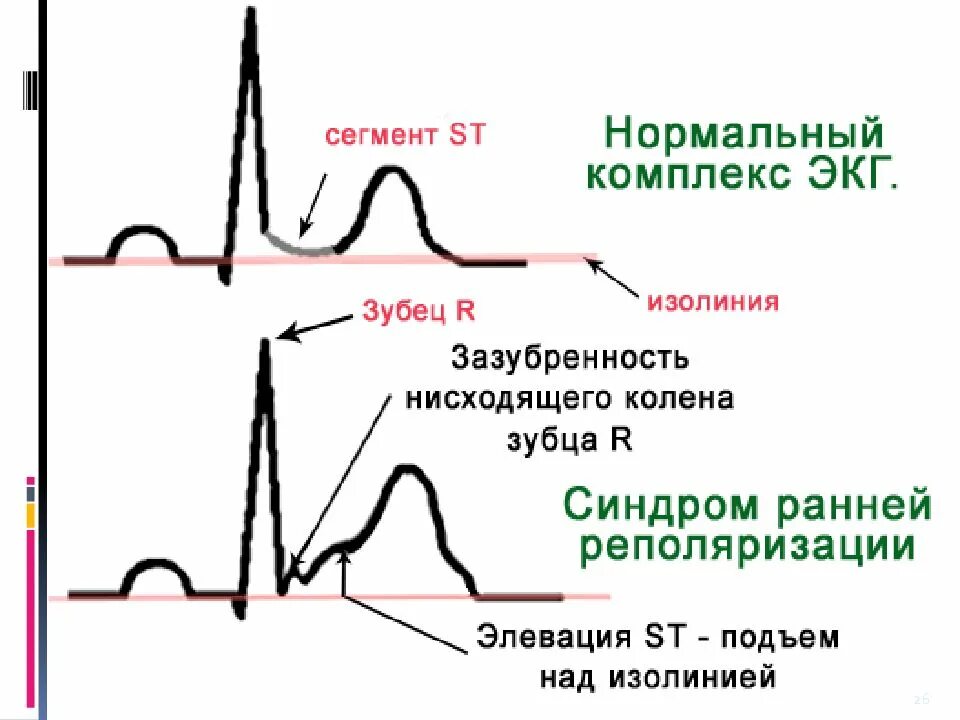 Изменение реполяризации левого желудочка. Ранняя реполяризация желудочков на ЭКГ. ЭКГ при синдроме ранней реполяризации желудочков. Синдром ранней деполяризации желудочков что это. Синдром ранней реполяризации ЭКГ критерии.