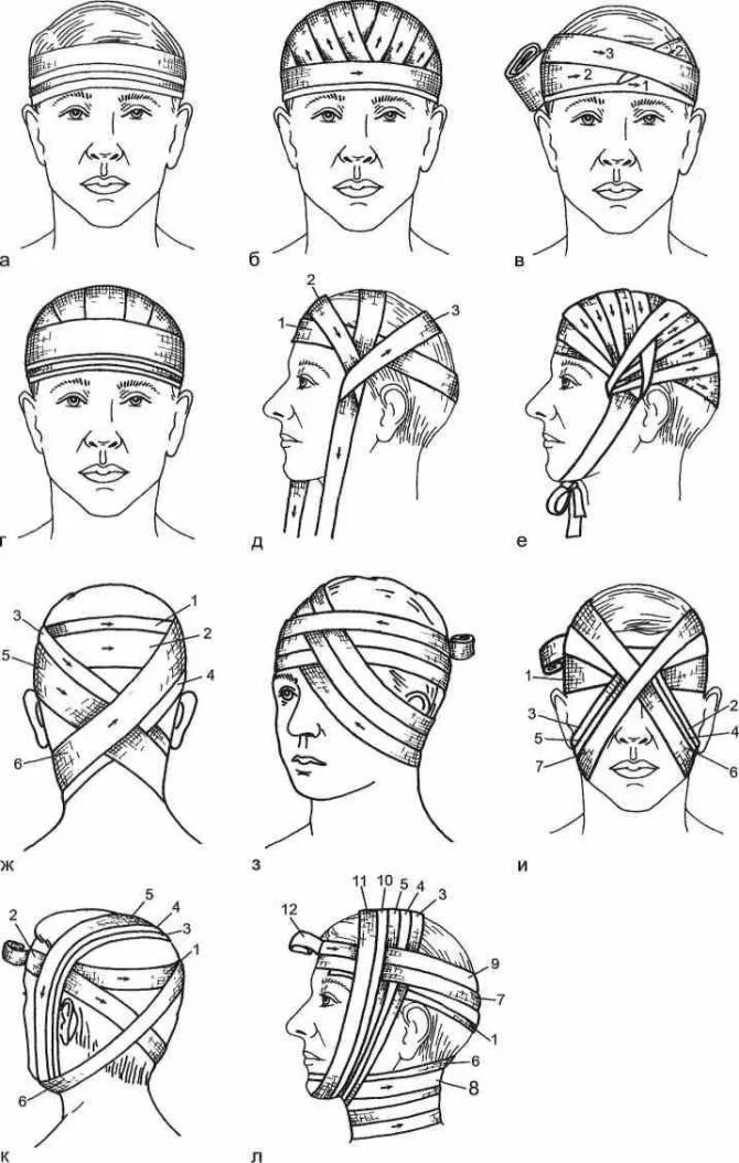 Как делать чепец. Десмургия повязка чепец. Перевязка головы чепец. Бинтование головы чепец. Перевязка головы чепец.